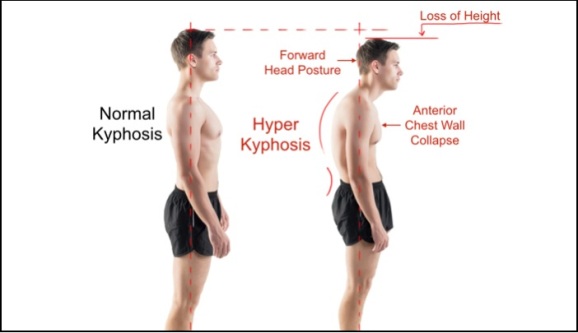 Kyphosis-Normal-vs-Hyper